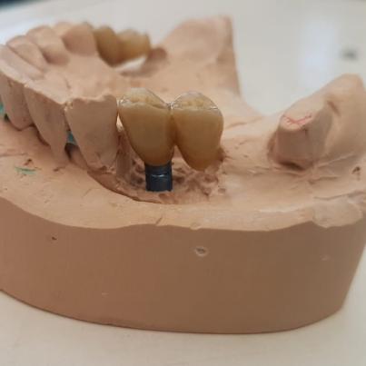 Perth dental prosthetics